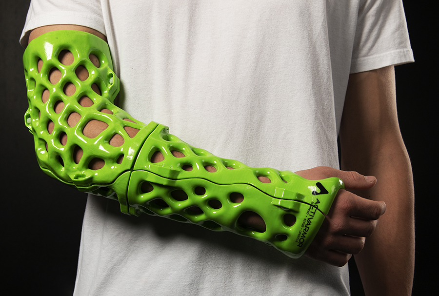 3D Printed Casts for Broken Limbs